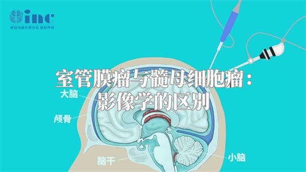 室管膜瘤与髓母细胞瘤：影像学的区别