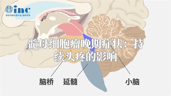 髓母细胞瘤晚期症状：持续头疼的影响