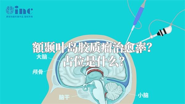 額颞叶岛胶质瘤治愈率？占位是什么？