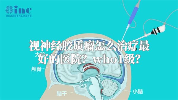 视神经胶质瘤怎么治疗最好的医院？who1级？