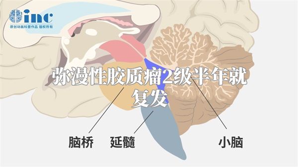 弥漫性胶质瘤2级半年就复发