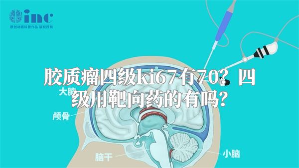 胶质瘤四级ki67有70？四级用靶向药的有吗？