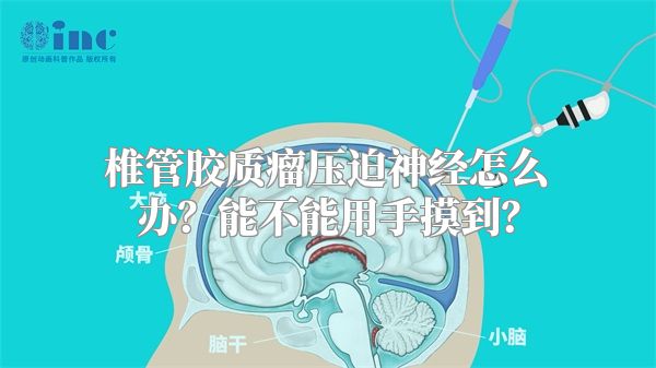 椎管胶质瘤压迫神经怎么办？能不能用手摸到？