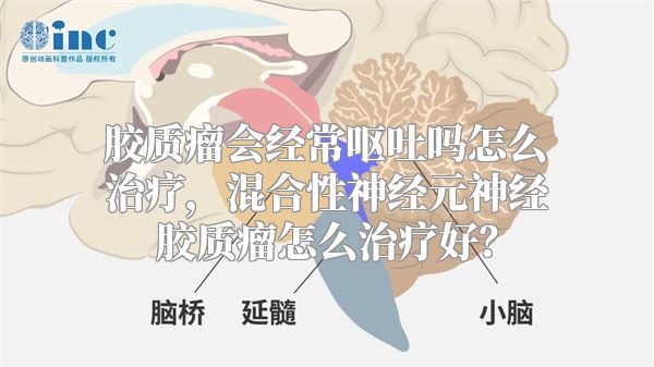 胶质瘤会经常呕吐吗怎么治疗，混合性神经元神经胶质瘤怎么治疗好？