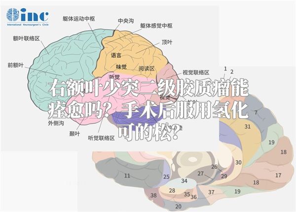 右额叶少突二级胶质瘤能痊愈吗？手术后服用氢化可的松？