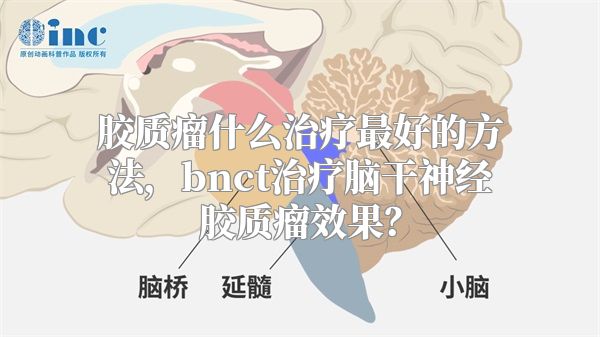 胶质瘤什么治疗最好的方法，bnct治疗脑干神经胶质瘤效果？