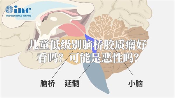 儿童低级别脑桥胶质瘤好看吗？可能是恶性吗？