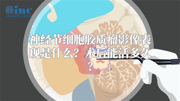 神经节细胞胶质瘤影像表现是什么？术后能活多久？