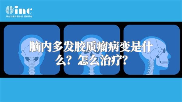 脑内多发胶质瘤病变是什么？怎么治疗？