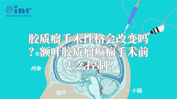 胶质瘤手术性格会改变吗？额叶胶质瘤癫痫手术前怎么控制？