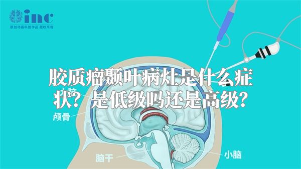 胶质瘤颞叶病灶是什么症状？是低级吗还是高级？