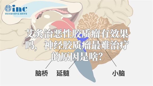 艾炙治恶性胶质瘤有效果吗，神经胶质瘤最难治疗的原因是啥？