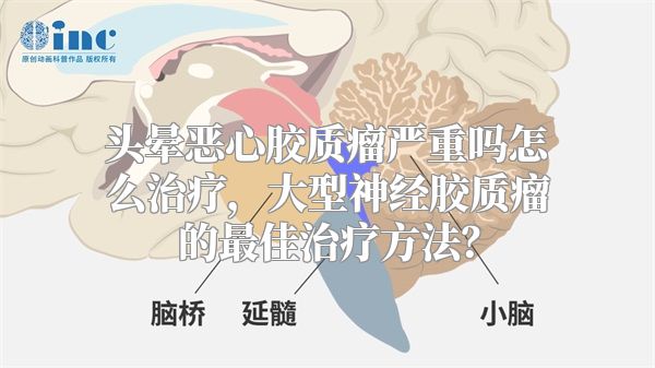 头晕恶心胶质瘤严重吗怎么治疗，大型神经胶质瘤的最佳治疗方法？