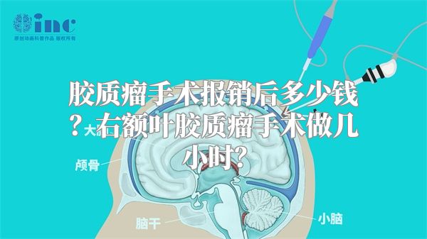 胶质瘤手术报销后多少钱？右额叶胶质瘤手术做几小时？