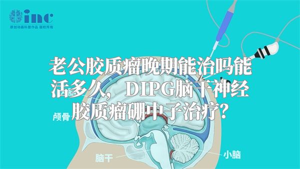 老公胶质瘤晚期能治吗能活多久，DIPG脑干神经胶质瘤硼中子治疗？