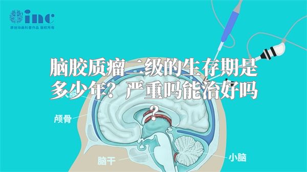 脑胶质瘤二级的生存期是多少年？严重吗能治好吗？