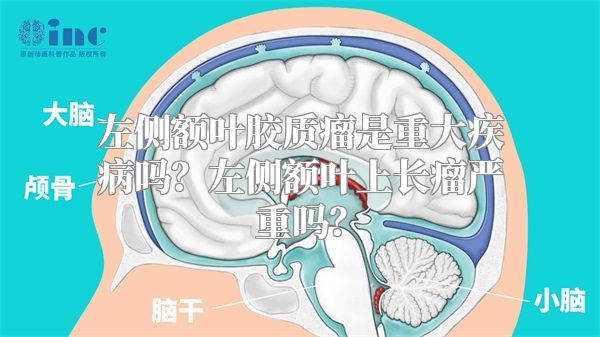 左侧额叶胶质瘤是重大疾病吗？左侧额叶上长瘤严重吗？