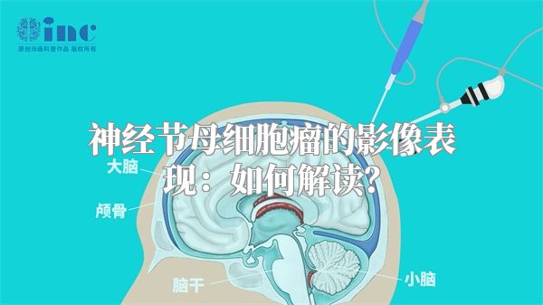 神经节母细胞瘤的影像表现：如何解读？