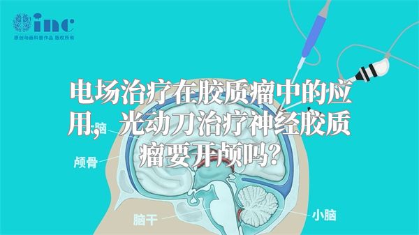 电场治疗在胶质瘤中的应用，光动刀治疗神经胶质瘤要开颅吗？