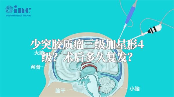 少突胶质瘤三级加星形4级？术后多久复发？