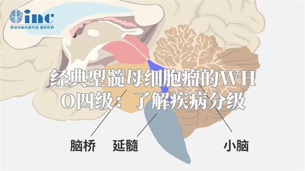 经典型髓母细胞瘤的WHO四级：了解疾病分级