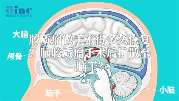 胶质瘤做手术得多久恢复？脑胶质瘤手术后扩散至脑干？