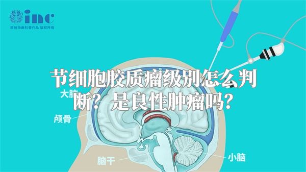 节细胞胶质瘤级别怎么判断？是良性肿瘤吗？