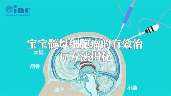 宝宝髓母细胞瘤的有效治疗方法揭秘