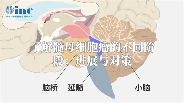 了解髓母细胞瘤的不同阶段：进展与对策