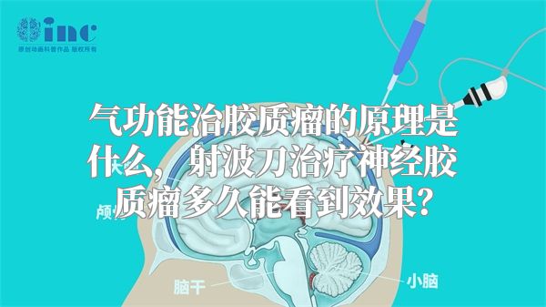 气功能治胶质瘤的原理是什么，射波刀治疗神经胶质瘤多久能看到效果？