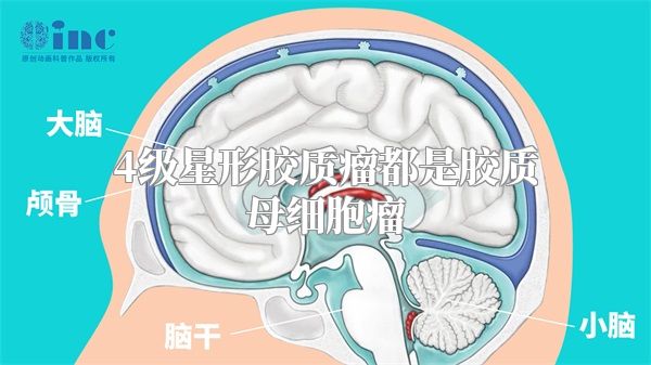 4级星形胶质瘤都是胶质母细胞瘤