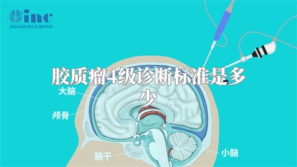 胶质瘤4级诊断标准是多少