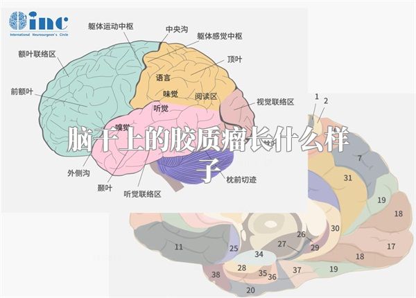 脑干上的胶质瘤长什么样子