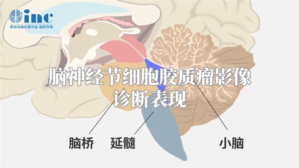 脑神经节细胞胶质瘤影像诊断表现