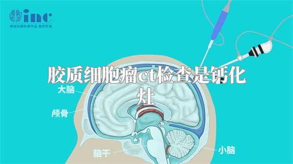 胶质细胞瘤ct检查是钙化灶