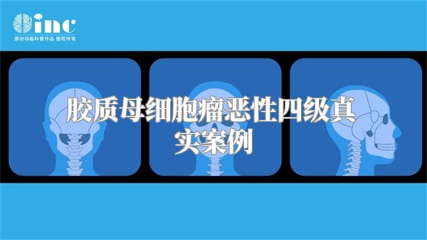 胶质母细胞瘤恶性四级真实案例