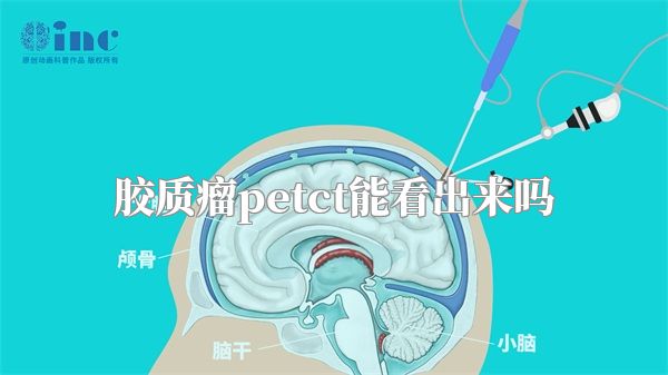 胶质瘤petct能看出来吗