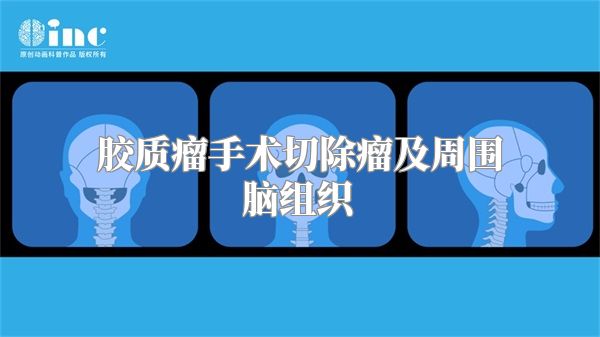 胶质瘤手术切除瘤及周围脑组织