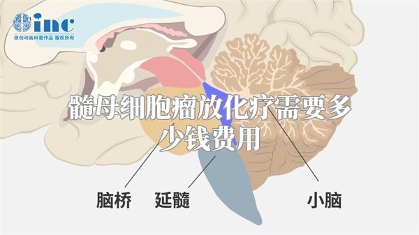 髓母细胞瘤放化疗需要多少钱费用