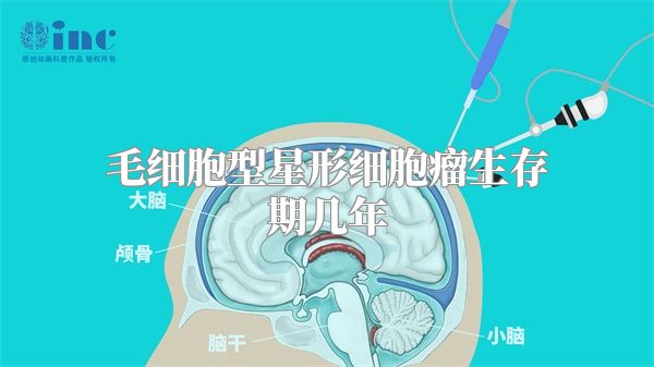 毛细胞型星形细胞瘤生存期几年