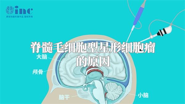 脊髓毛细胞型星形细胞瘤的原因