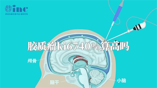 胶质瘤ki6740%算高吗