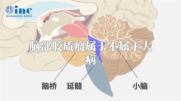 脑部胶质瘤属于不属于大病