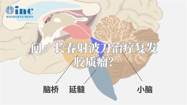 问：长春射波刀治疗复发胶质瘤？