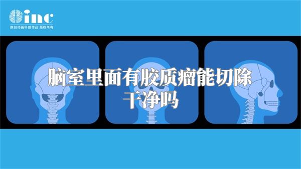 脑室里面有胶质瘤能切除干净吗