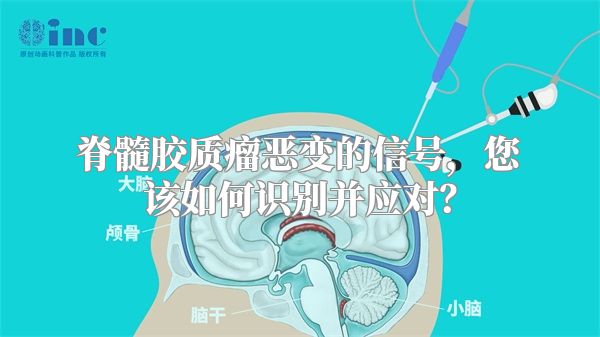 脊髓胶质瘤恶变的信号，您该如何识别并应对？