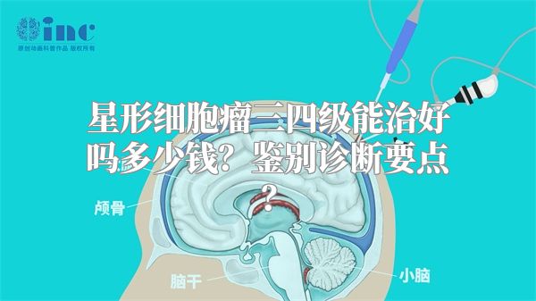 星形细胞瘤三四级能治好吗多少钱？鉴别诊断要点？