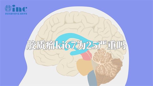 胶质瘤ki67为25严重吗