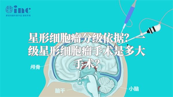 星形细胞瘤分级依据？一级星形细胞瘤手术是多大手术？