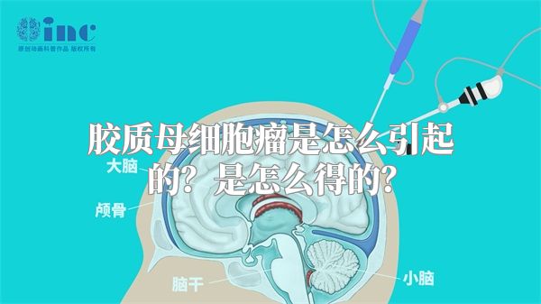 胶质母细胞瘤是怎么引起的？是怎么得的？